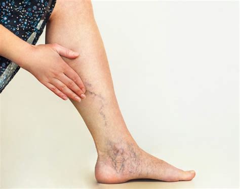 When A Leg Rash Is From Vein And Vascular Issues Precision Vascular