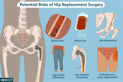 Hip Replacement Surgery Recovery What To Expect More
