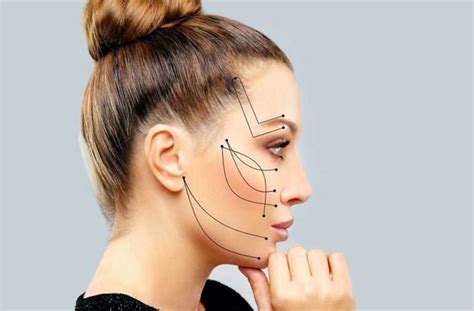 Facial Sculpting Thread Lifts In Chicago Mini Facelift Cosmetic Treatment