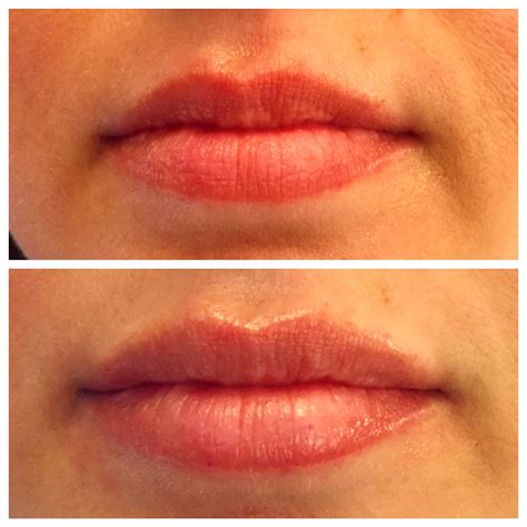 Juvederm Filled Lips Before And After Photos Dental Makeover Simple