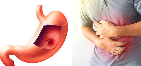 Quels sont les signes d un ulcère à l estomac Quels sont les aliments