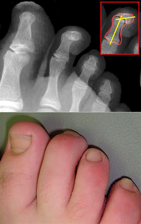 What Is Hammer Toe American Foot And Leg Specialists