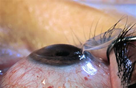 Epithelium Off Corneal Crosslinking Has Low Risk Of Early Complications