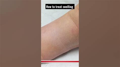 How To Fix Swelling In Legs How To Treat Edema In Legs And Ankles