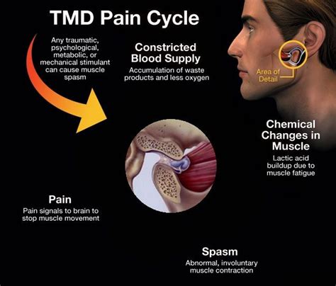 Read About ‪‎tmj‬ Symptoms And Treatments ‪‎tmd‬ ‪‎facialpain