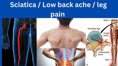Sciatica Low Back Ache Leg Pain Symptoms Causes Risk Factors Prevention