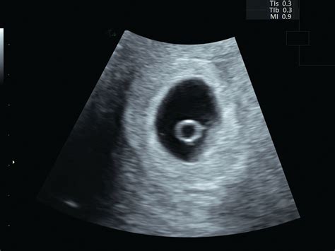 Ultrasound Is A Critical Tool Of Managing Miscarriage