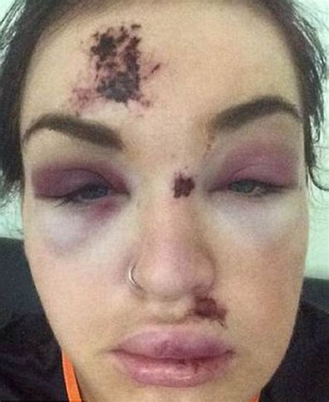Clubber Suffers Horrific Bruises After Being Punched Repeatedly In The