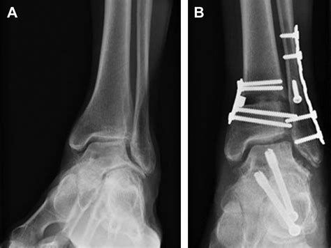 Supramalleolar Osteotomy Clinics In Podiatric Medicine And Surgery