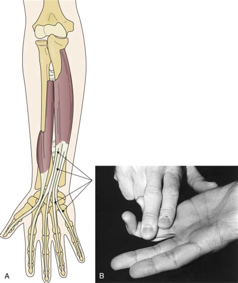 Ulnar Neuropathy Wrist Musculoskeletal Key