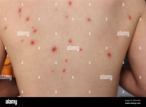 Chickenpox Spots And Scabs On A Childs Back And Tummy Stock Photo Alamy