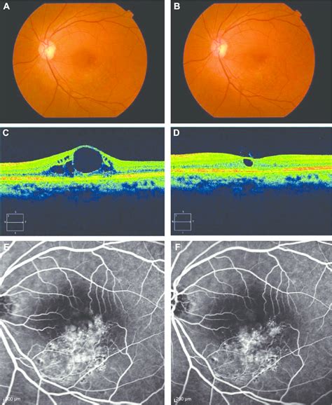 Images Of The Left Eye Of A 68 Year Old Woman With Branch Retinal Vein