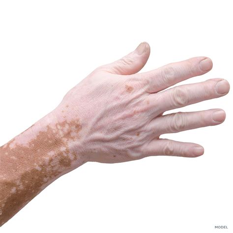 Vitiligo White Spot Conditions California Skin Institute