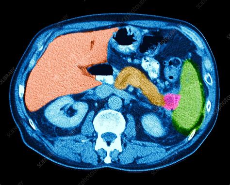 Pancreatic Cancer CT Scan Stock Image C Science Photo
