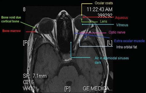 Orbit Mri Anatomy Radiology Anatomy Images