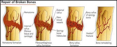 The inflammation phase is the first stage of healing. HEALING A BROKEN BONE - Creation Engineering Concepts
