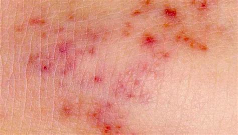 Meningitis Rash Pictures Symptoms And Similar Rashes