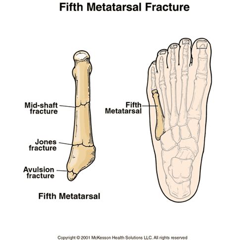 It's amazing how one protein impacted fracture healing, says daniell, corresponding author on the paper. Breaking Down Kevin Durant's Jones Fracture - In Street ...