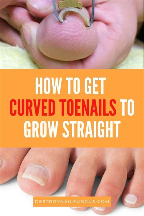 Pin By Agnes On Prevent Ingrown Toe Nails Curved Toenails Ingrown