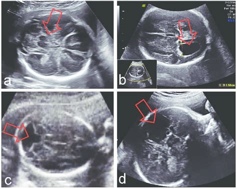 Fetal Anomalies Ultrasound