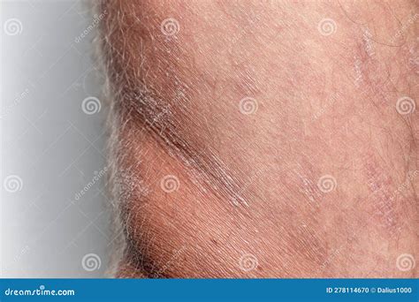 Large Plaque Parapsoriasis On Caucasian Man Legs Stock Photo Image Of