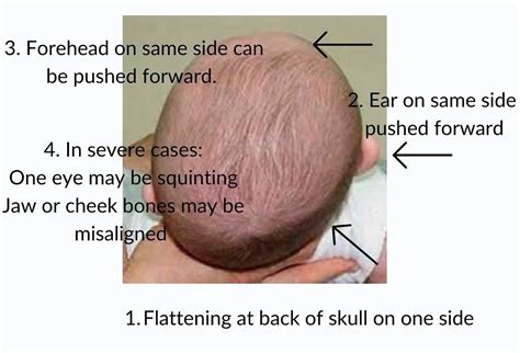How To Recognise Plagiocephaly Or A Flat Head In Your Baby And What