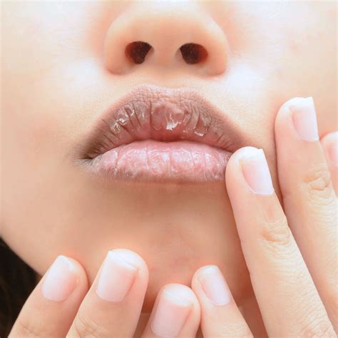 How To Avoid Dry Lips Hirebother13