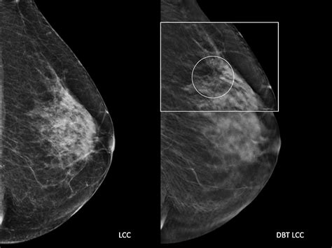 Effect Of Integrating 3d Mammography Digital Breast Tomosynthesis