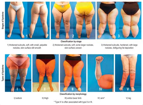 The Staging And Typological Classification Of Lipedema Download Scientific Diagram