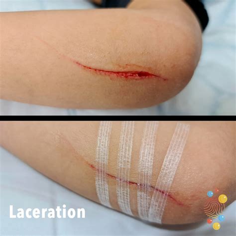 Lacerations Skin Deep