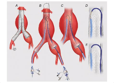 Iliac Artery Aneurysm Repair Hot Sex Picture