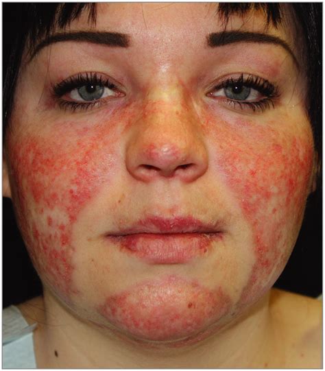 lupus what causes the lupus butterfly rash redorbit find out about treatment and how you