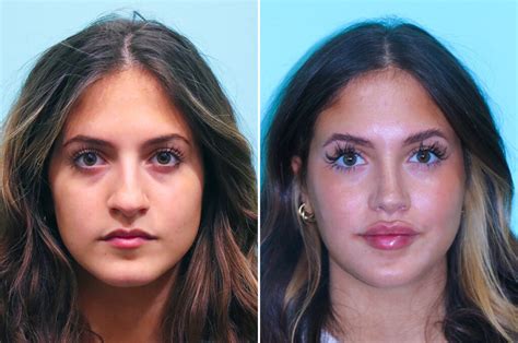 Lip Augmentation Before And After Photos The Naderi Center For