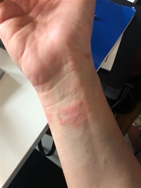 Allergic To Watchband Apple Community