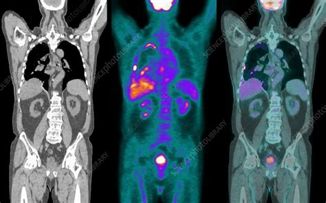 Mesothelioma Lung Cancer Ct And Pet Stock Image C0213595