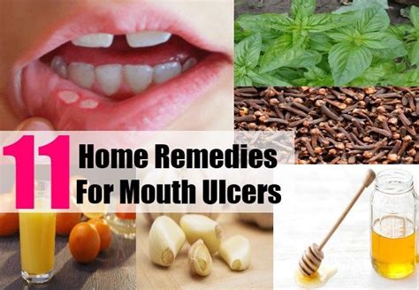 11 Home Remedies For Mouth Ulcers Mouth Ulcer Home Remedy Ulcer