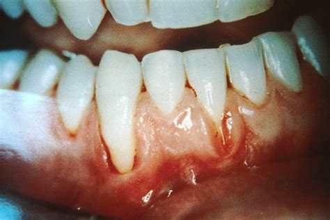 Gum Cancer Causes Symptoms Treatment Pictures Signs Healthmd