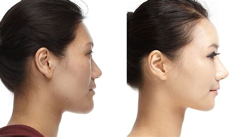 How To Fix A Protruding Chin Magnum Workshop
