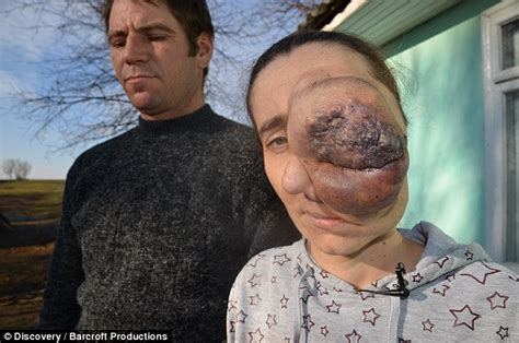Romanian Mother With Her Tumor Growing Around Her Eye Hopes It Can Be