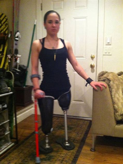 102 Learning My Balance New Prosthetic Legs Double Amputee Otosection