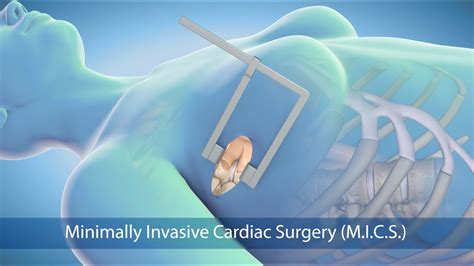 Medical Animation Minimally Invasive Cardiac Surgery Mics At