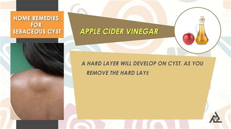 Home Remedies For Sebaceous Cyst Best Health And Beauty Tips