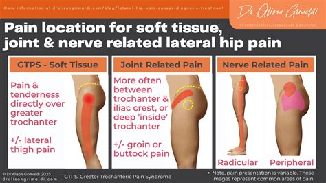 Gluteus Medius Pain At Iliac Crest