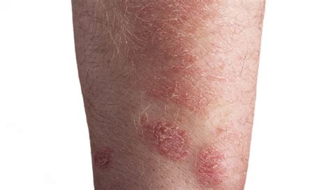 Biologics May Up Fungal Infection Risk In Patients With Psoriasis