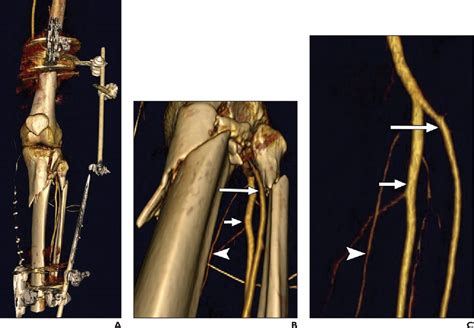 Figure 11—45 From Ct Angiography Signs Of Lower Extremity Vascular