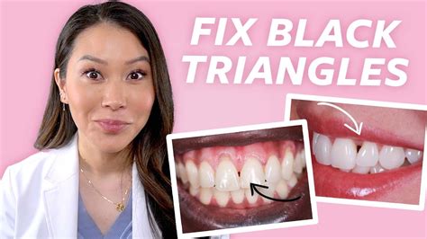 Fix Gaps In Teeth How To Close Black Triangles Youtube