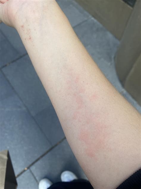 Red Itchy Rash All Over Body Rdermatologyquestions