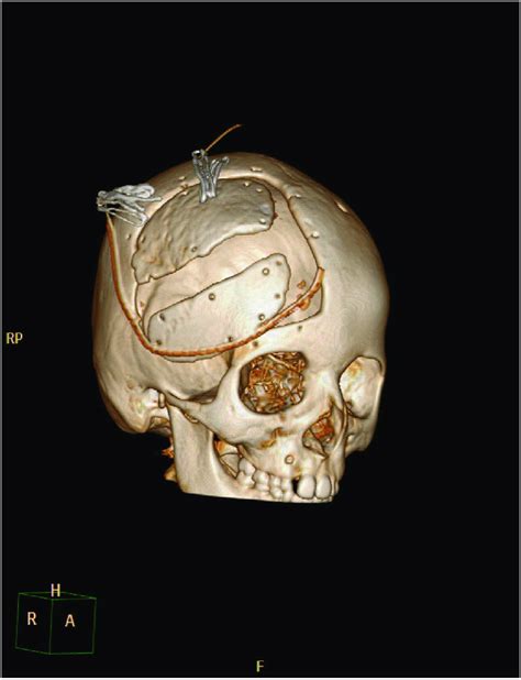Postoperative Cranial Ct After Cranioplasty 3d Reconstruction