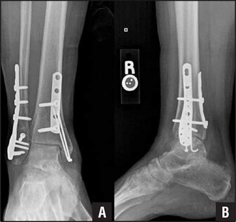 Open Reduction And Internal Fixation Of Posterior Malleolus Fractures