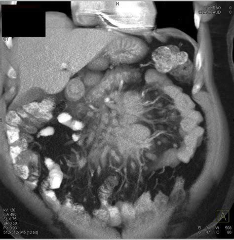 Lymphoma With Nodes In The Root Of The Mesentery Small Bowel Case